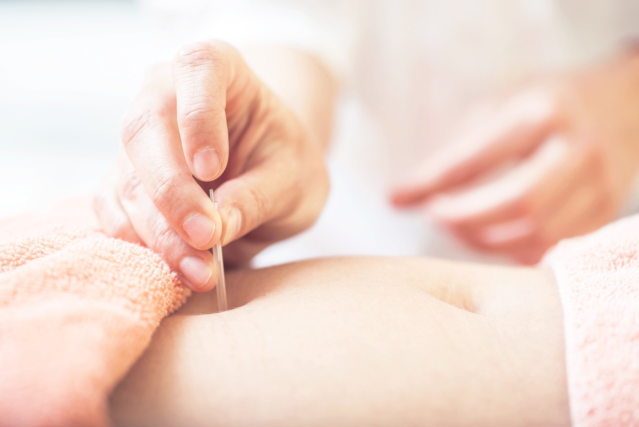 Woman on acupuncture