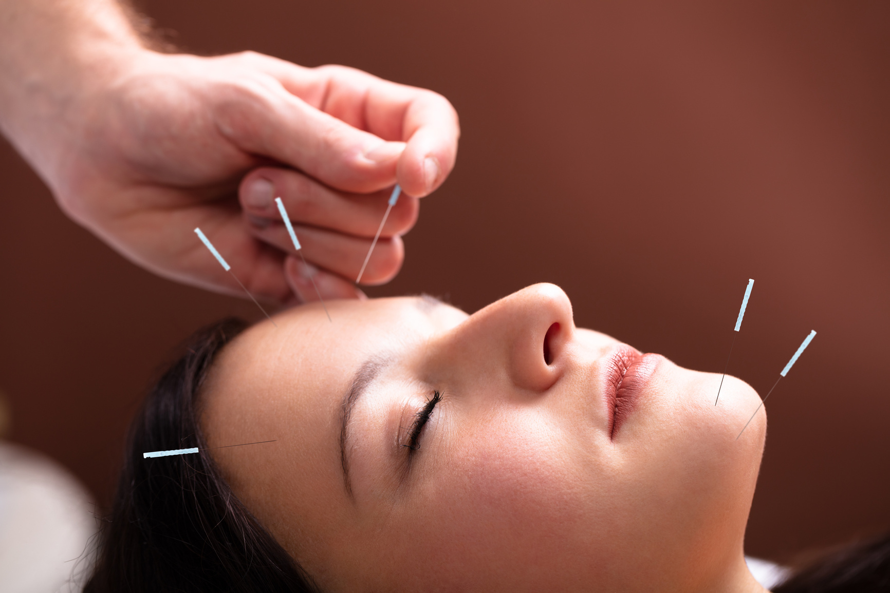 Woman Receiving Acupuncture Treatment On Her Face