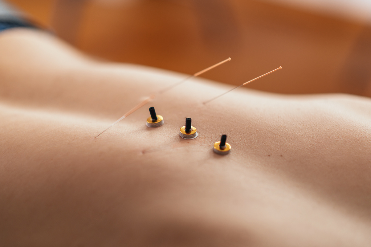 Acupuncture and moxibustion treatment